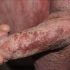 شانکروئید (Chancroid) یک بیماری زخمی دستگاه تناسلی و عفونت منتقله از راه جنسی است که با زخم های نرم (بدون تحریک) با مرزهای نامنظم و لنفادنوپاتی اینگوینال حساس یا حباب مشخص می شود. ارگانیسم ایجاد کننده ، Haemophilus ducreyi  است.